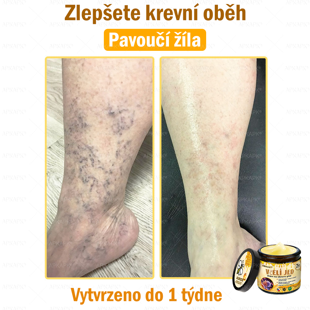 Dermatologicky a klinicky testováno👩‍⚕️👩‍⚕️APKAPK®Bee Venom Krém na obnovení pleti🐝 pomáhá při léčbě kožních problémů, jako jsou: vrásky, jizvy, pigmentové skvrny, strie, akné, psoriáza, ekzém, kožní změny, podráždění, záněty a další kožní problémy. 👩‍⚕️