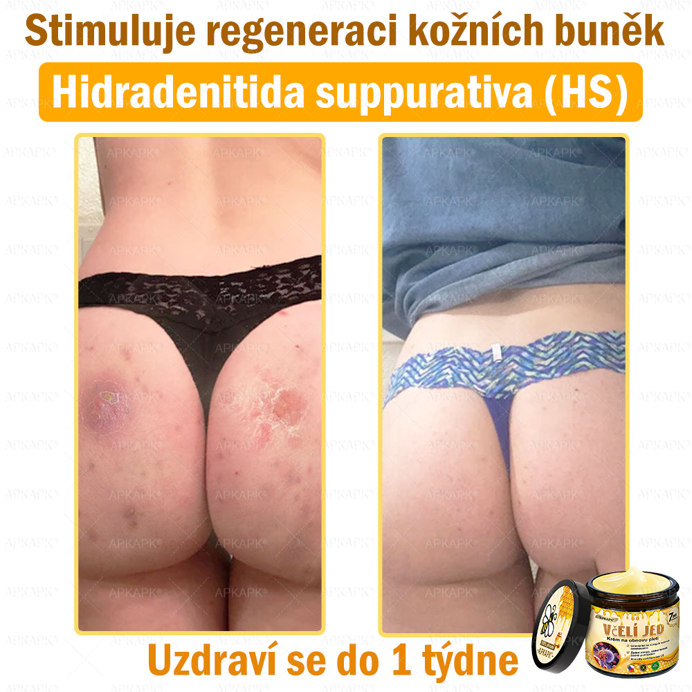 Dermatologicky a klinicky testováno👩‍⚕️APKAPK®Bee Venom Krém na obnovení pleti🐝 pomáhá při léčbě kožních problémů, jako jsou: vrásky, jizvy, pigmentové skvrny, strie, akné, psoriáza, ekzém, kožní změny, podráždění, záněty a další kožní problémy.