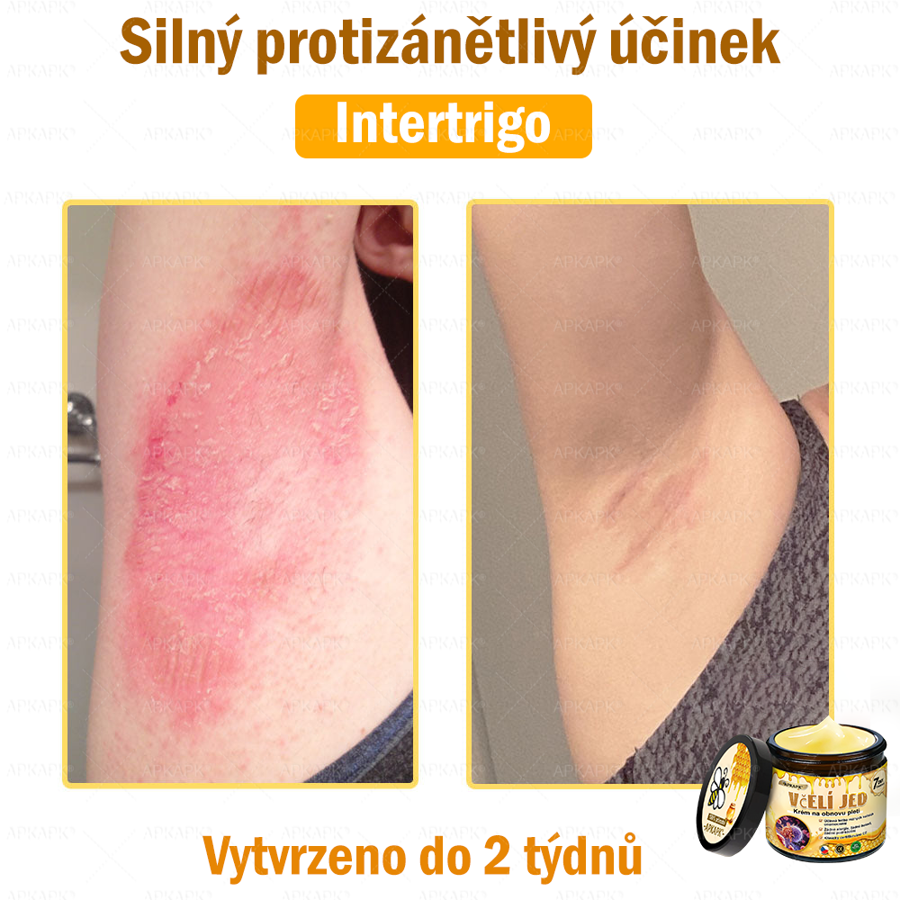 Dermatologicky a klinicky testováno👩‍⚕️APKAPK®Bee Venom Krém na obnovení pleti🐝 pomáhá při léčbě kožních problémů, jako jsou: vrásky, jizvy, pigmentové skvrny, strie, akné, psoriáza, ekzém, kožní změny, podráždění, záněty a další kožní problémy.