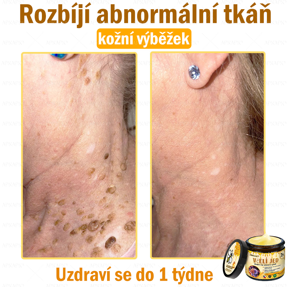 Dermatologicky a klinicky testováno👩‍⚕️👩‍⚕️APKAPK®Bee Venom Krém na obnovení pleti🐝 pomáhá při léčbě kožních problémů, jako jsou: vrásky, jizvy, pigmentové skvrny, strie, akné, psoriáza, ekzém, kožní změny, podráždění, záněty a další kožní problémy. 👩‍⚕️