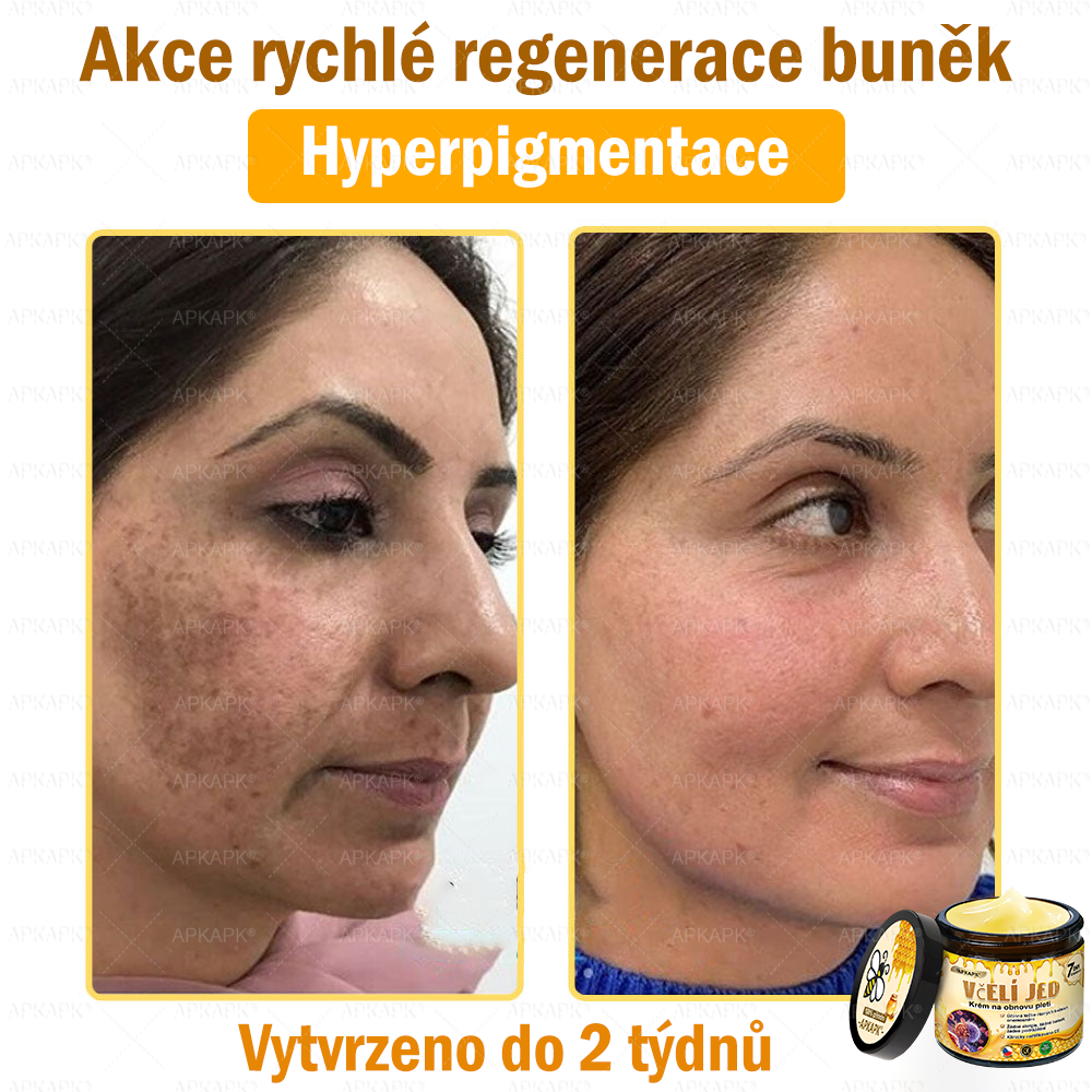 Dermatologicky a klinicky testováno👩‍⚕️👩‍⚕️APKAPK®Bee Venom Krém na obnovení pleti🐝 pomáhá při léčbě kožních problémů, jako jsou: vrásky, jizvy, pigmentové skvrny, strie, akné, psoriáza, ekzém, kožní změny, podráždění, záněty a další kožní problémy. 👩‍⚕️